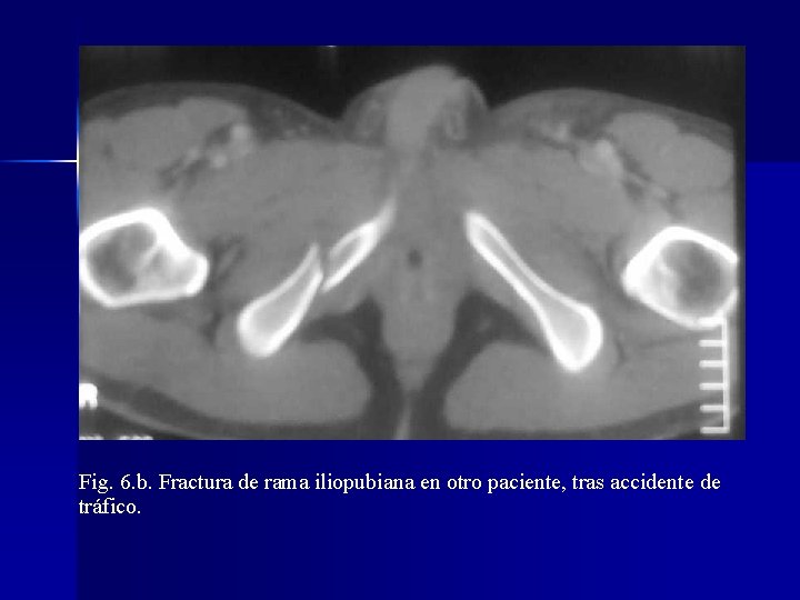 Fig. 6. b. Fractura de rama iliopubiana en otro paciente, tras accidente de tráfico.