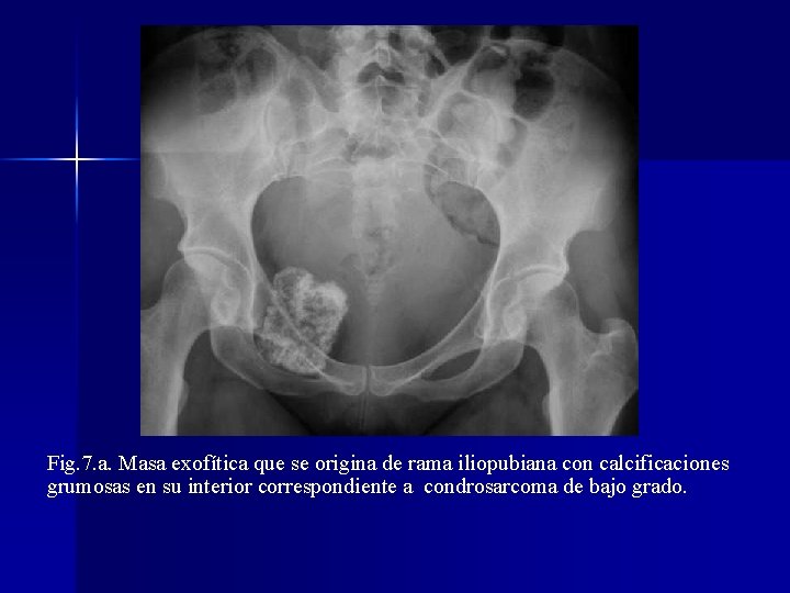 Fig. 7. a. Masa exofítica que se origina de rama iliopubiana con calcificaciones grumosas