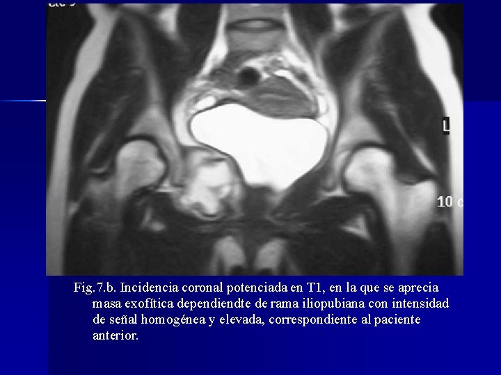 Fig. 7. b. Incidencia coronal potenciada en T 1, en la que se aprecia