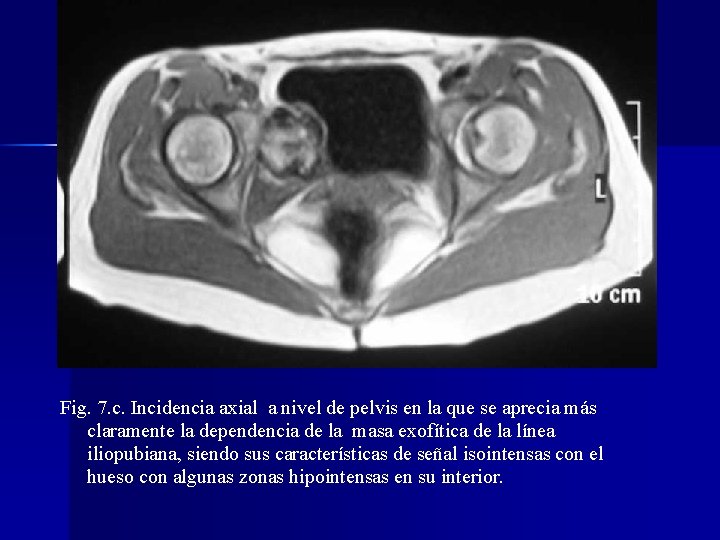 Fig. 7. c. Incidencia axial a nivel de pelvis en la que se aprecia