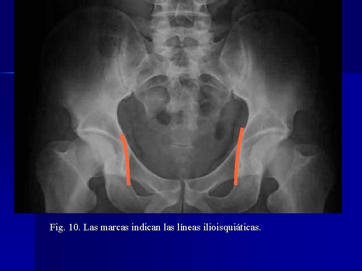 Fig. 10. Las marcas indican las líneas ilioisquiáticas. 