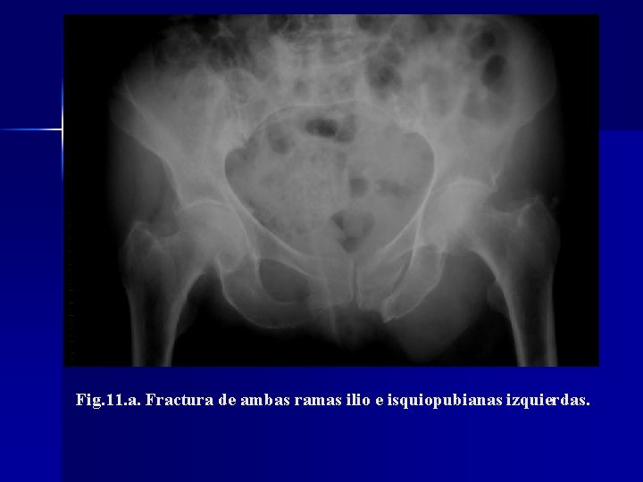 Fig. 11. a. Fractura de ambas ramas ilio e isquiopubianas izquierdas. 