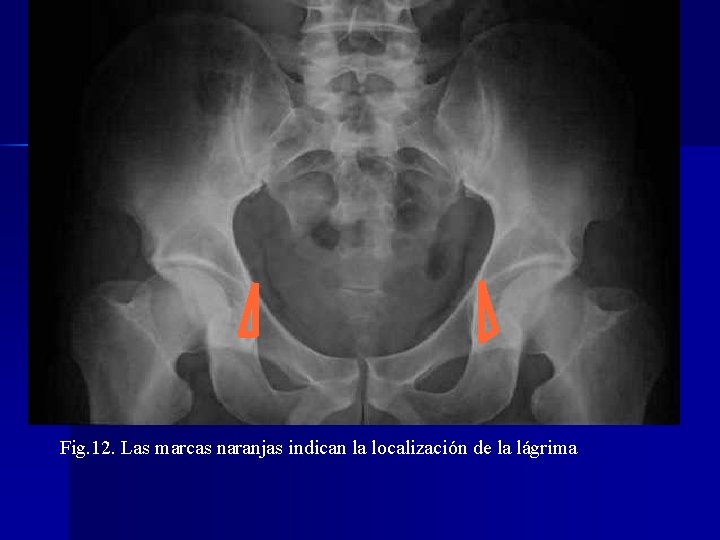 Fig. 12. Las marcas naranjas indican la localización de la lágrima 