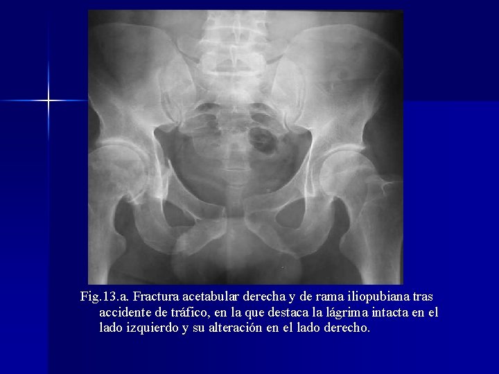 Fig. 13. a. Fractura acetabular derecha y de rama iliopubiana tras accidente de tráfico,