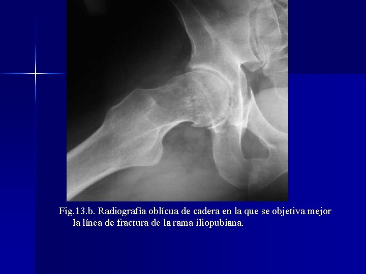 Fig. 13. b. Radiografía oblícua de cadera en la que se objetiva mejor la