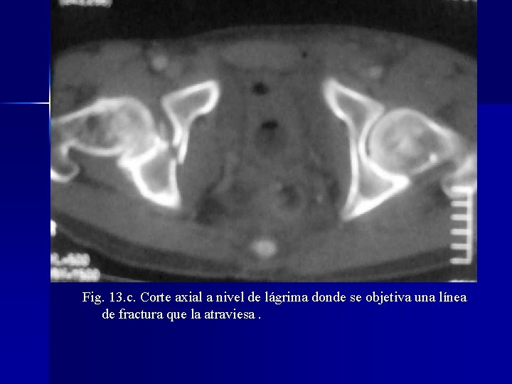 Fig. 13. c. Corte axial a nivel de lágrima donde se objetiva una línea
