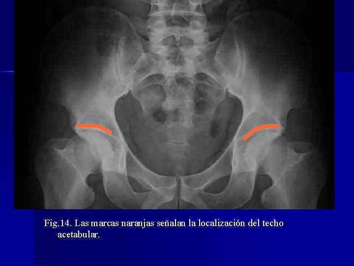 Fig. 14. Las marcas naranjas señalan la localización del techo acetabular. 