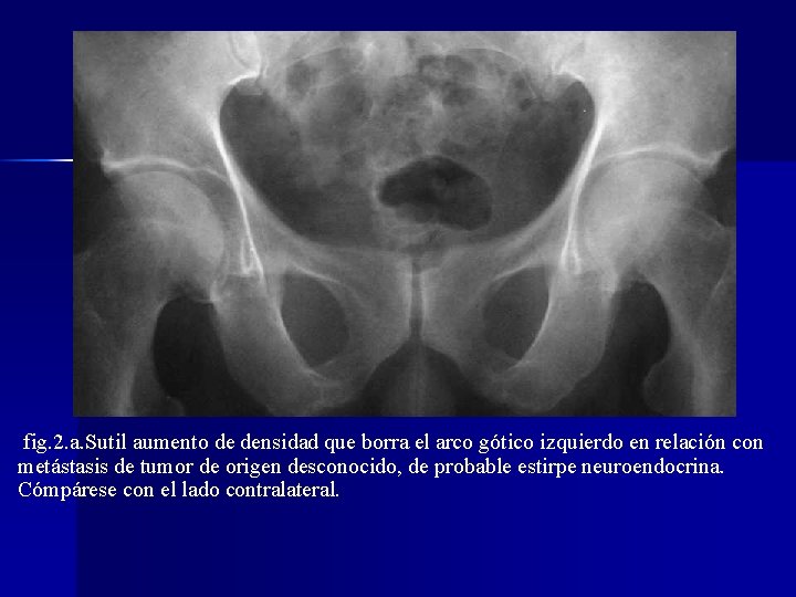 fig. 2. a. Sutil aumento de densidad que borra el arco gótico izquierdo en