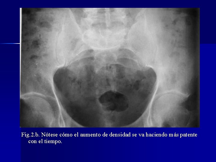 Fig. 2. b. Nótese cómo el aumento de densidad se va haciendo más patente