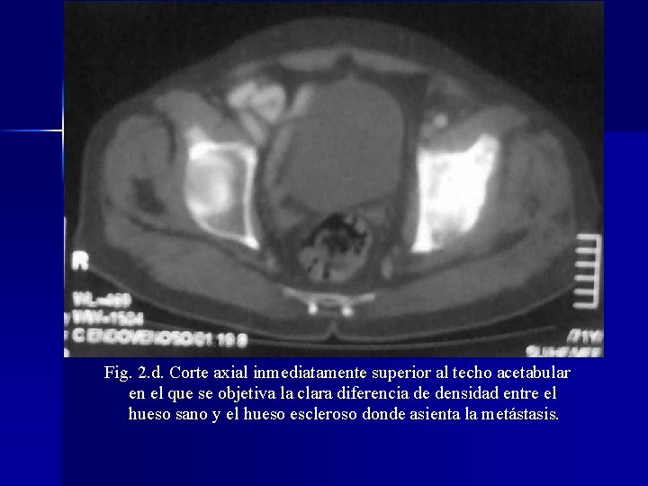 Fig. 2. d. Corte axial inmediatamente superior al techo acetabular en el que se