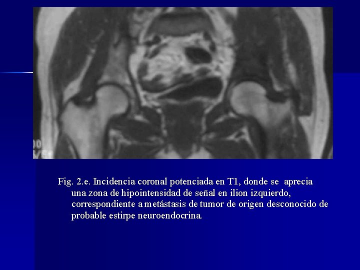Fig. 2. e. Incidencia coronal potenciada en T 1, donde se aprecia una zona