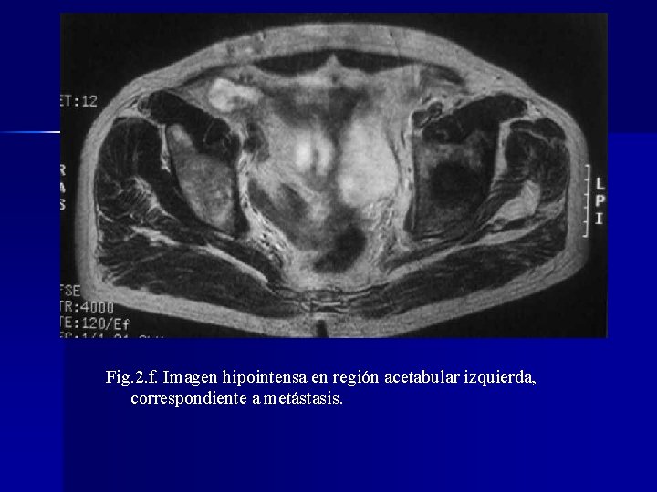 Fig. 2. f. Imagen hipointensa en región acetabular izquierda, correspondiente a metástasis. 