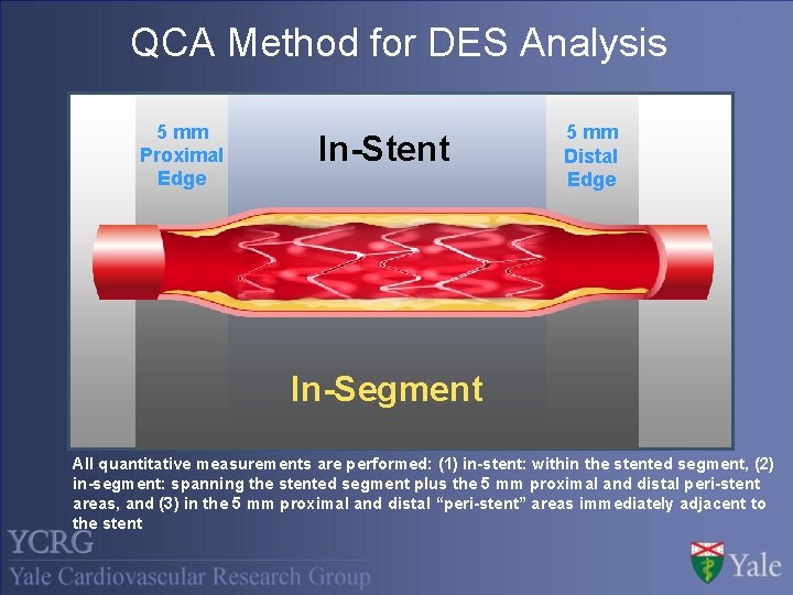 QCA Method for DES Analysis 5 mm Proximal Edge In-Stent 5 mm Distal Edge