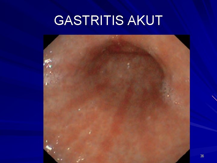 GASTRITIS AKUT 36 GASTRITIS AKUT 36