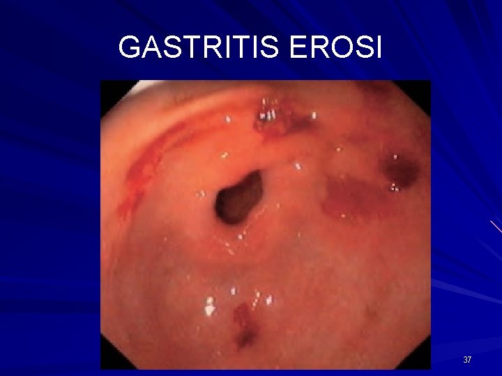 GASTRITIS EROSI 37 