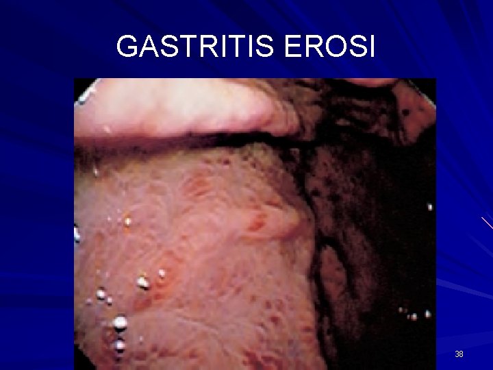 GASTRITIS EROSI 38 