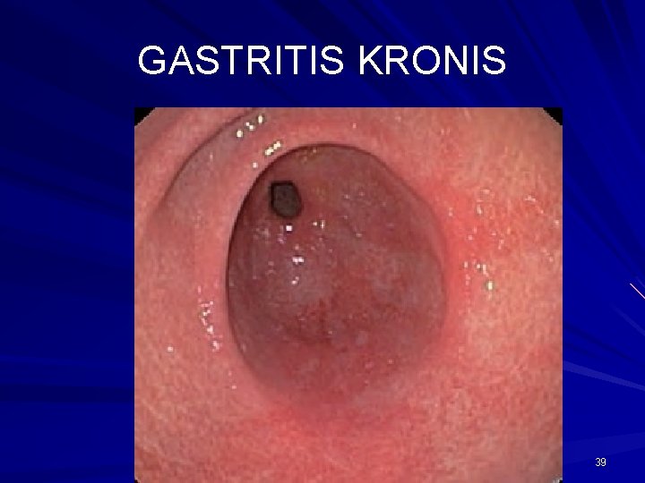 GASTRITIS KRONIS 39 GASTRITIS KRONIS 39