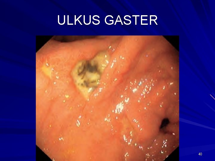 ULKUS GASTER 40 ULKUS GASTER 40