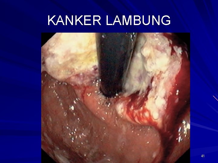 KANKER LAMBUNG 41 