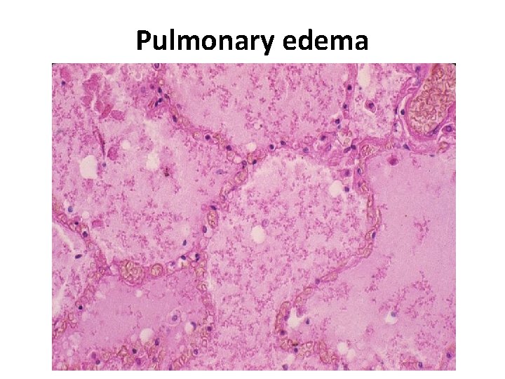 Pulmonary edema 