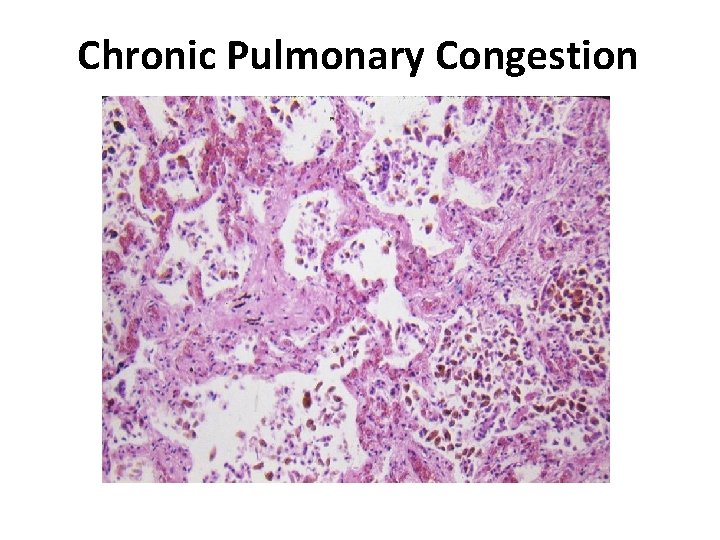 Chronic Pulmonary Congestion 