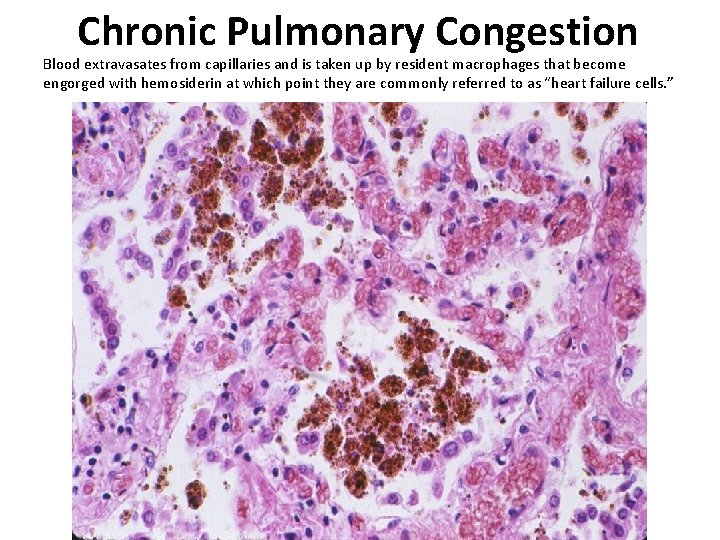 Chronic Pulmonary Congestion Blood extravasates from capillaries and is taken up by resident macrophages