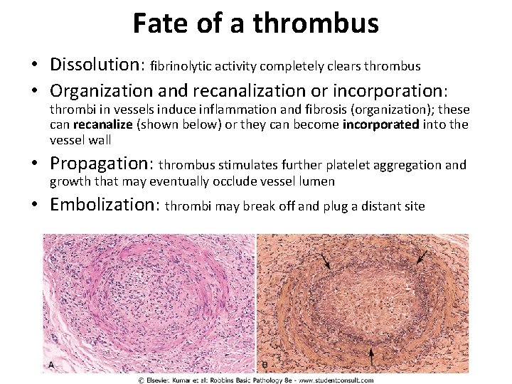 Fate of a thrombus • Dissolution: fibrinolytic activity completely clears thrombus • Organization and