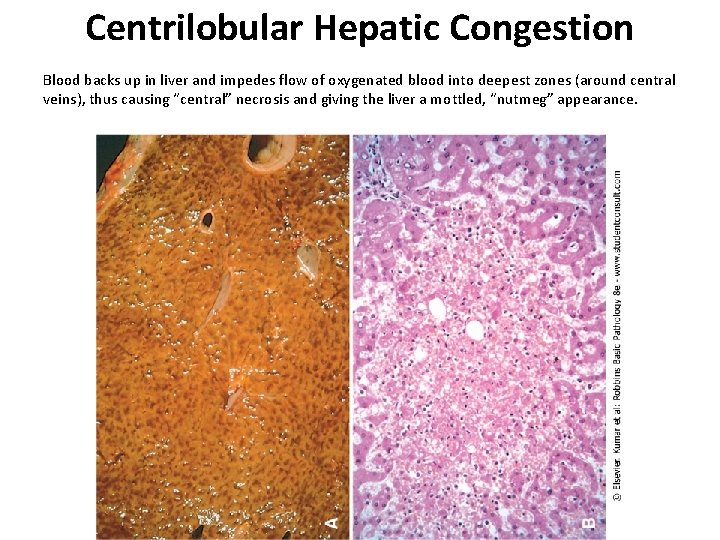 Centrilobular Hepatic Congestion Blood backs up in liver and impedes flow of oxygenated blood