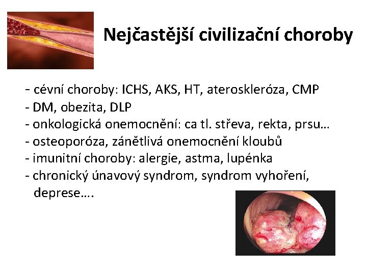 Nejčastější civilizační choroby - cévní choroby: ICHS, AKS, HT, ateroskleróza, CMP - DM, obezita,