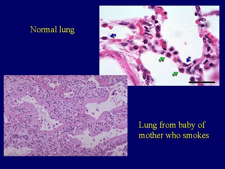 Normal lung Lung from baby of mother who smokes 