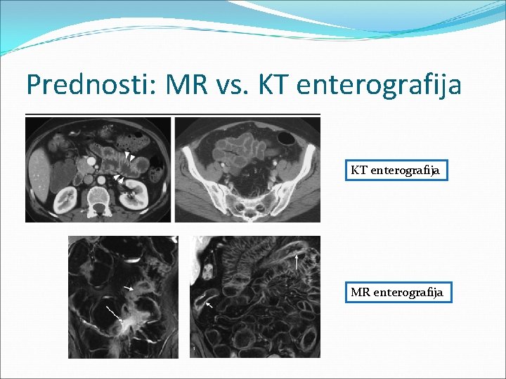 Prednosti: MR vs. KT enterografija MR enterografija 