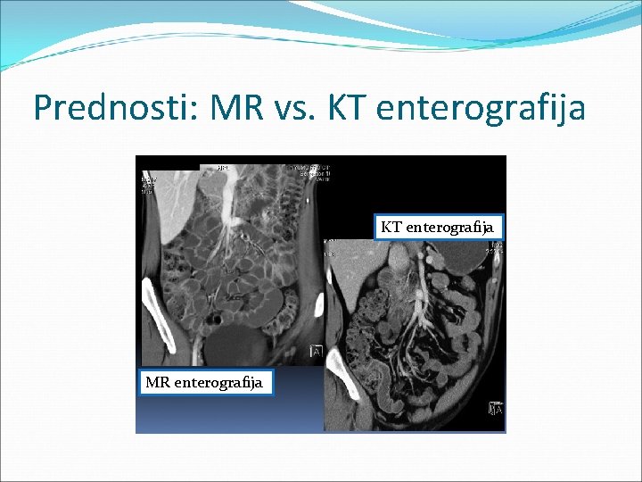 Prednosti: MR vs. KT enterografija MR enterografija 