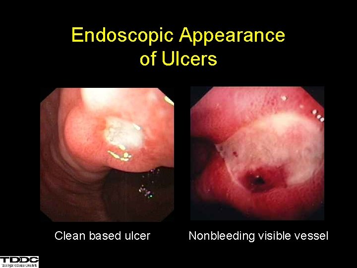 Endoscopic Appearance of Ulcers Clean based ulcer Nonbleeding visible vessel 