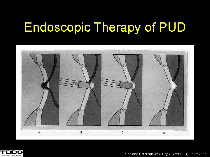 Endoscopic Therapy of PUD Laine and Peterson New Eng J Med 1994; 331: 717