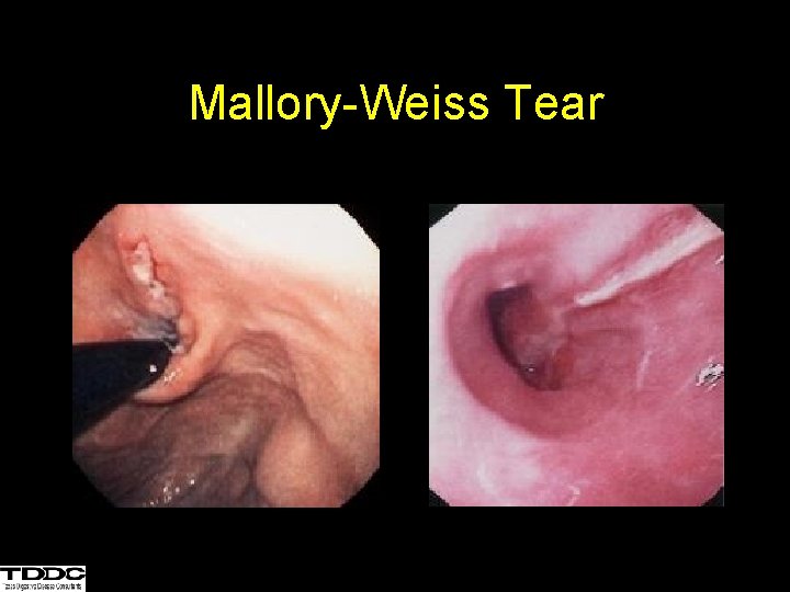 Mallory-Weiss Tear 