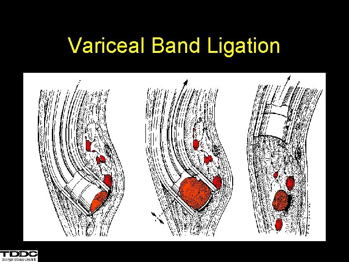 Variceal Band Ligation 