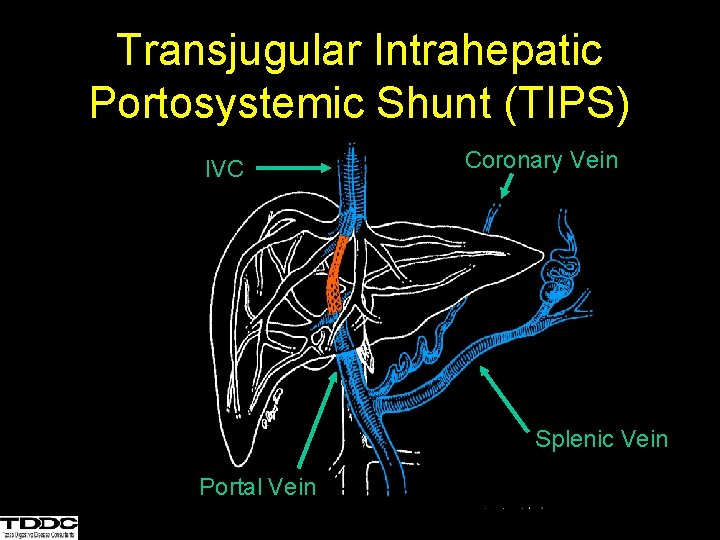 Transjugular Intrahepatic Portosystemic Shunt (TIPS) IVC Coronary Vein Splenic Vein Portal Vein 