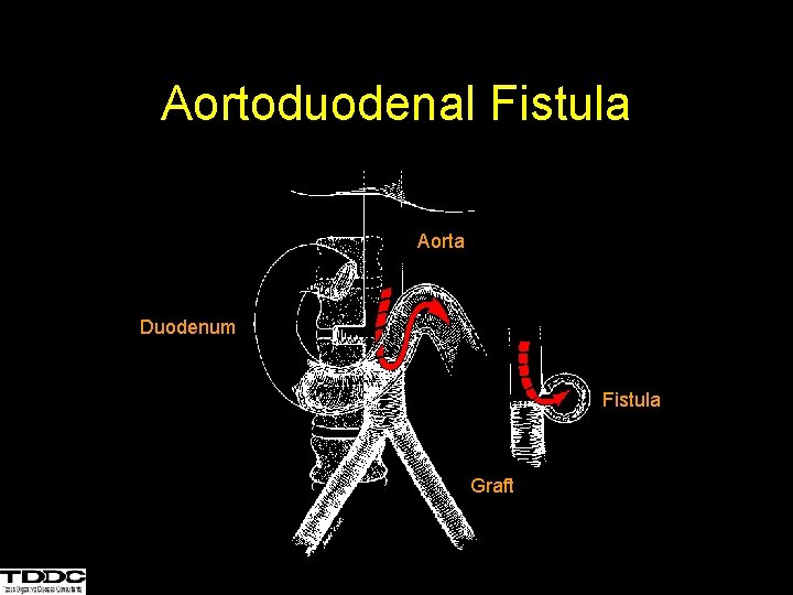 Aortoduodenal Fistula Aorta Duodenum Fistula Graft 