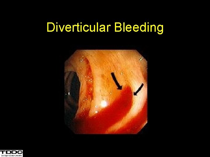 Diverticular Bleeding 