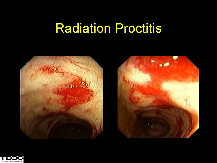 Radiation Proctitis 