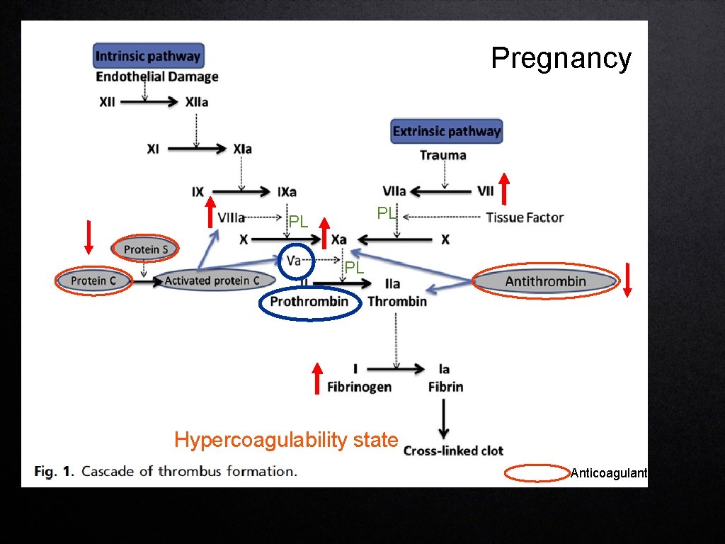 Pregnancy PL PL PL Hypercoagulability state Anticoagulant 