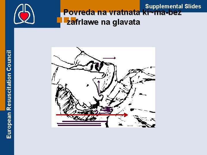 Supplemental Slides European Resuscitation Council Povreda na vratnata ki~ma-bez zafrlawe na glavata 