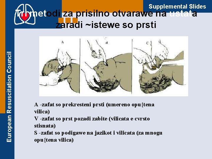 Supplemental Slides European Resuscitation Council Tri metodi za prisilno otvarawe na ustata zaradi ~istewe