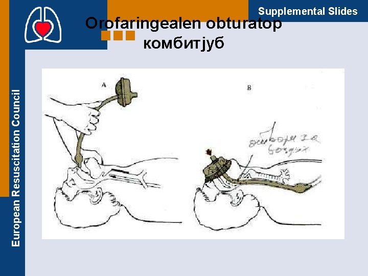 Supplemental Slides European Resuscitation Council Orofaringealen obturatoр комбитјуб 