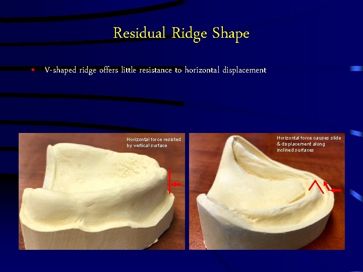 Residual Ridge Shape • V-shaped ridge offers little resistance to horizontal displacement Horizontal force