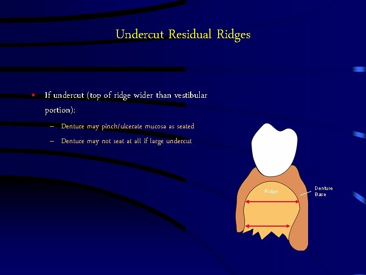 Undercut Residual Ridges • If undercut (top of ridge wider than vestibular portion): – Undercut Residual Ridges • If undercut (top of ridge wider than vestibular portion): –