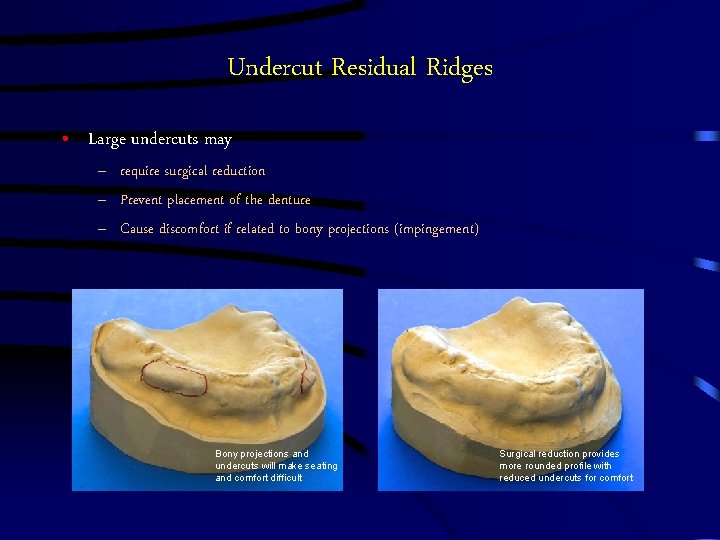 Undercut Residual Ridges • Large undercuts may – require surgical reduction – Prevent placement Undercut Residual Ridges • Large undercuts may – require surgical reduction – Prevent placement