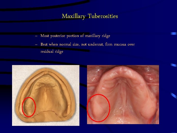 Maxillary Tuberosities – Most posterior portion of maxillary ridge – Best when normal size,