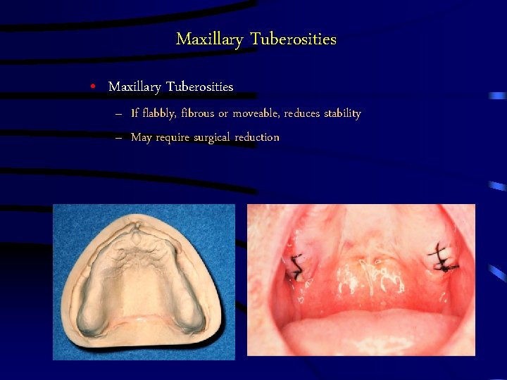 Maxillary Tuberosities • Maxillary Tuberosities – If flabbly, fibrous or moveable, reduces stability – Maxillary Tuberosities • Maxillary Tuberosities – If flabbly, fibrous or moveable, reduces stability –