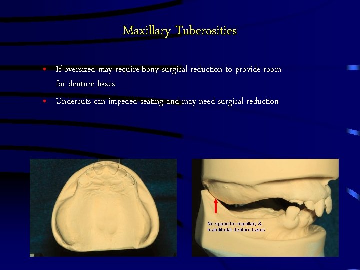 Maxillary Tuberosities • If oversized may require bony surgical reduction to provide room for Maxillary Tuberosities • If oversized may require bony surgical reduction to provide room for